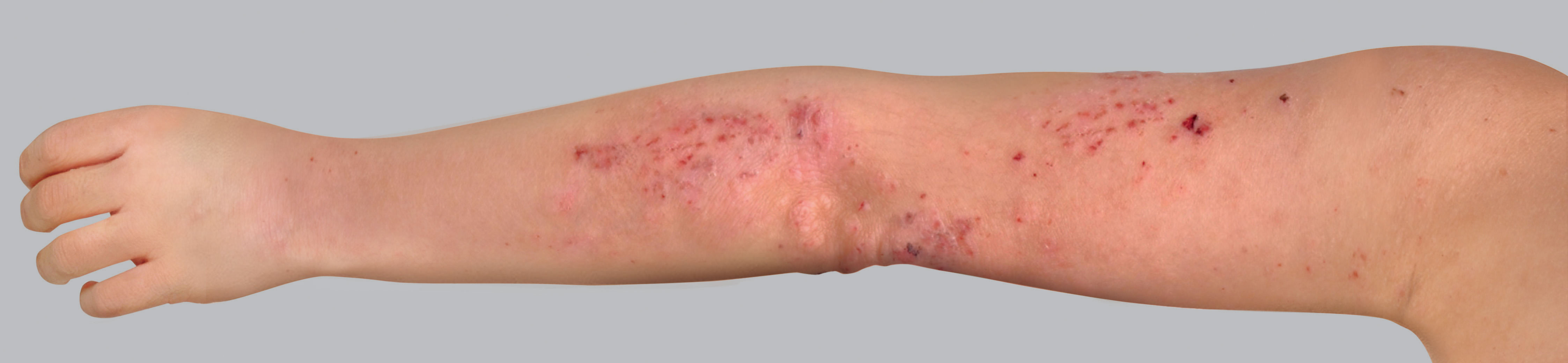 Sintomas do eczema atópico: lesões de coceira ou escoriação