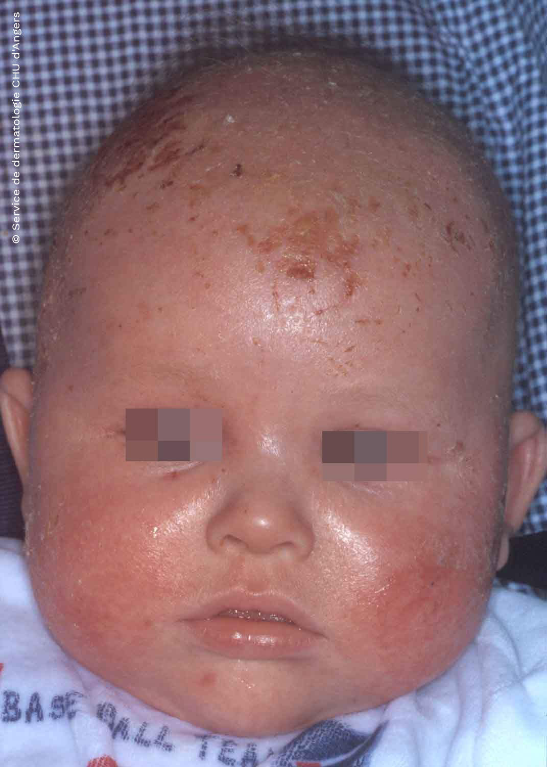 Eczema Du Visage Fondation Eczema