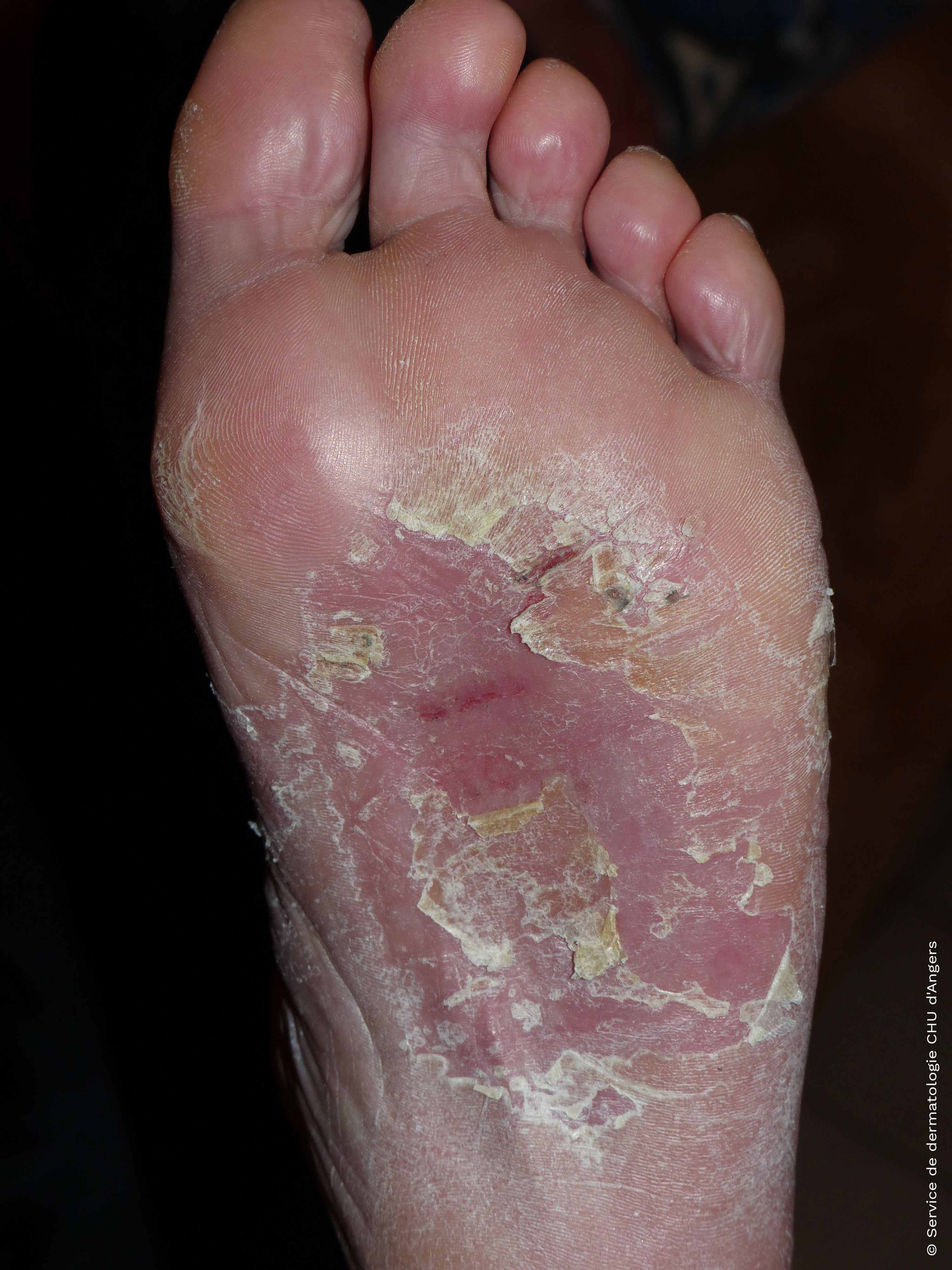 Eczema on the feet Eczema Foundation