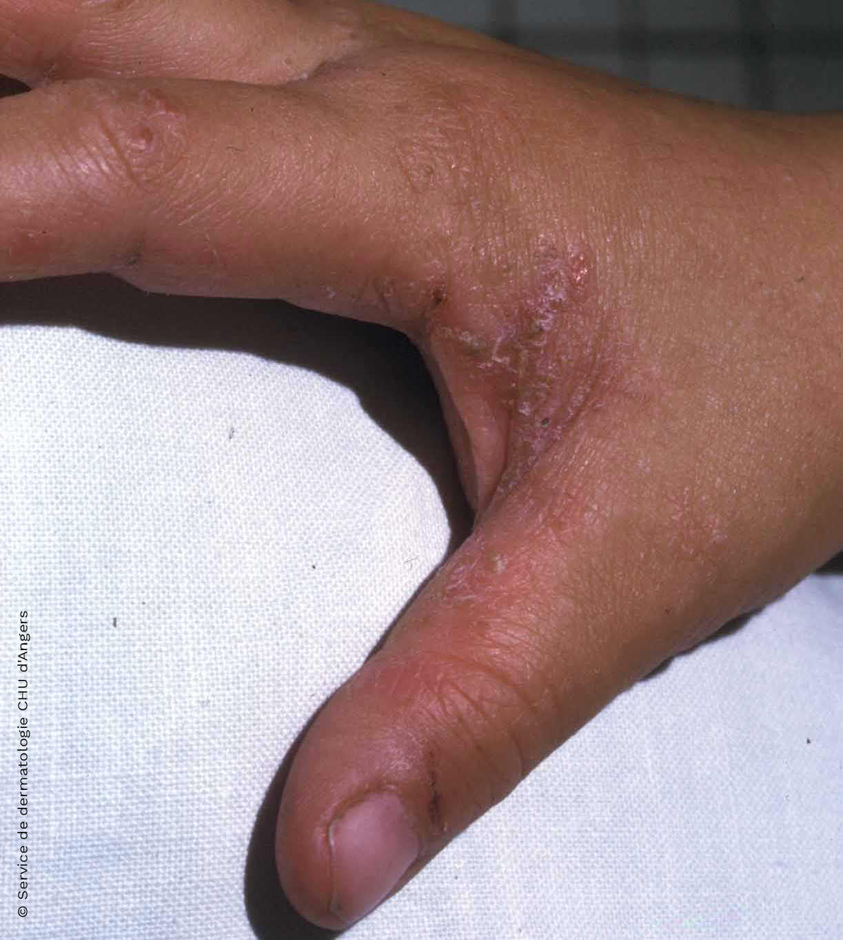 eczema ou gale fondation eczema